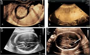 Ultrasound Diagnosis Of Infections In Pregnancy European Journal Of Obstetrics And Gynecology And Reproductive Biology
