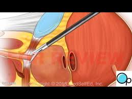 Image result for Radical Prostatectomy