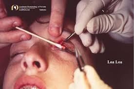 Image result for Tropical Edema