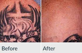 They may also accept medical loans or credit cards. Laser Tattoo Removal Genesis Medspa Jefferson City Missouri