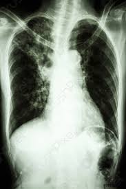 For decades, tuberculosis (tb), a potentially serious infectious lung disease, continues to be a leading cause of worldwide death. Www Crushpixel Com Big Static19 Preview4 Pulmon