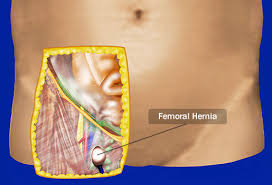 Hiatus hernia, as it is commonly called. Visual Guide To Hernias