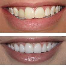 Best Dental Clinic And Surgery Care In India Is Offered By Himachaldental Com We Have Professional And Qualified Veneers Teeth Cosmetic Dentist Dental Veneers