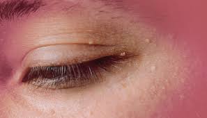 Image result for milium cyst on eyelid