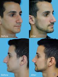 This Patient Was Unhappy With His Large Nose Dorsal Hump 3 Months After Rhinoplasty He S Feeling Much More Rinoplastia Cirugia Estetica Reto De Fotografia