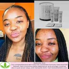 Tla ke go thuse go ntsha di pimple mo facing App 76198540 or drop number