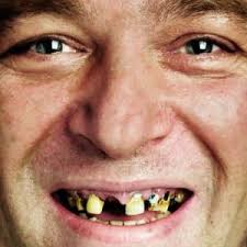 After reading the article, you can also click on the link to read more about a similar topic on a swollen cheek if you have a rotten tooth that is causing you pain, it is a good idea for you to see a dentist instead of attempting to pull it out yourself. How To Fix Rotten Teeth Rotten Teeth Teeth Care Bad Teeth