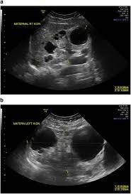 Fetal Imaging Prompts Maternal Diagnosis Autosomal Dominant Polycystic Kidney Disease Journal Of Perinatology