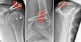 Morfometría del acromion y sus implicancias clínicas. Surgical Reconstruction Of The Anterolateral Acromion With A Tricortical Iliac Crest Bone Graft After Extensive Acromioplasty Springerlink