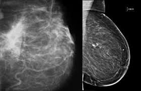 Generally, whiter mammogram images indicate denser breasts. Mammography In Breast Cancer Background X Ray Mammography Ultrasound