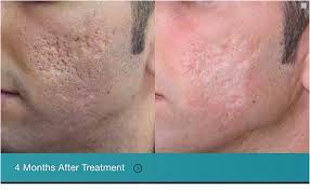 We did not find results for: Fractional Laser Resurfacing Horizon Dermatology Cosmetic Center Horizon Dermatology Cosmetic Center