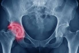 Image result for Hip XRay