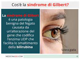 Quando si soffre della sindrome di gilbert non c'è ragione di modificare la propria dieta e la quantità di esercizio fisico, mentre restano valide le raccomandazioni generali sulla necessità di seguire uno stile di vita sano e attivo, seguendo un'alimentazione varia ed equilibrata, ricca di frutta e verdura, evitando. Sindrome Di Gilbert Cos E Sintomi Dieta E Rimedi Per Il Morbo