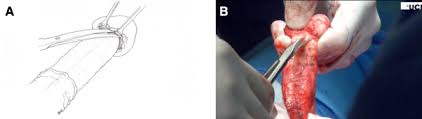 We found 4 dictionaries with english definitions that include the word bucks fascia: Glansectomy And Split Thickness Skin Graft For Penile Cancer European Urology