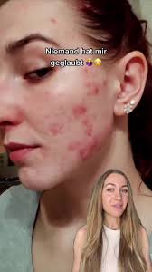 Melanie hat dank der probiotischen Hautpflege von Hautliebe ihre Haut  transformiert 😳🔄 Hormonelle Hautprobleme sind sehr hartnäckig, doch wenn  die Hautflora in Balance ist, können Pickel effektiv ...