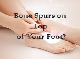 Vind de beste gratis stockfoto's over bone spur on top of foot treatment uk. How To Care For Bone Spurs On Top Of Your Foot Indiana Podiatry Group