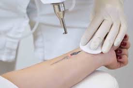 How can i get a tattoo removed? Reasons Why Laser Tattoo Removal Is The Best Better Off