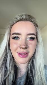 Staph Infections Kayla Blue Eye