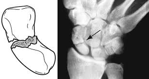Image result for Scaphoid Bone