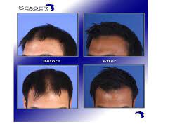 Dr Cam Simmons 20 Months After 4100 Grafts Were Transplanted To The Forelock And Midscalp For A Norwood 3v Pat Straight Hairstyles Hair Transplant Transplant