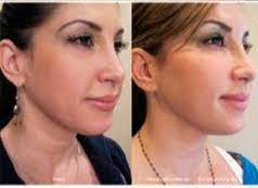 Therefore, the process of mobile apps development follows through. Ultherapy Face Neck Chin Jowls Tightening Near Me Nj Price Cost