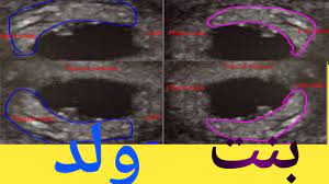 الفرق بين شكل كيس الحمل فى ذكر وكيس الحمل فى انثى فى اول الحمل youtube
