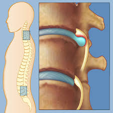 Stomach the digestive organ, it is located in the upper abdomen, under ribs, kind of a big sac that digests food. Herniated Disc Weill Cornell Brain And Spine Center