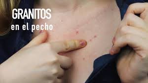 3 Maneras De Eliminar Los Granitos Del Pecho Asepxia Youtube