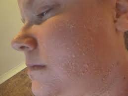 Half way through i applied sunscreen. Sunscreen Allergy Allergy Symptoms
