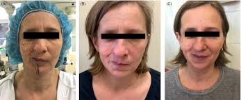 Autologous fat transfer for facial recontouring in Parry‐Romberg syndrome