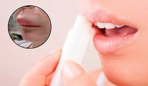 Check spelling or type a new query. Ini 5 Penyebab Bibir Bengkak Pasca Bangun Pagi Jangan Lekas Panik