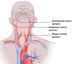 Iz Za Chego Voznikaet Okklyuziya Sonnoj Arterii Chto Takoe Stenoz Sonnoj Arterii Ili Pochemu Suzhaetsya Arteriya Operacii Pri Izvitosti Sonnyh Arterij