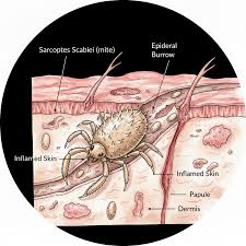 Image result for Sarcoptes scabiei