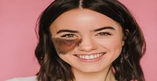 يتحدث الدكتور بيرج عن أهم الفيتامينات للعينين. ÙˆØµÙØ§Øª Ø·Ø¨ÙŠØ¹ÙŠØ© Ù„Ù„ØªØ®Ù„Øµ Ù…Ù† ÙˆØ­Ù…Ø© Ø§Ù„ÙˆØ¬Ù‡ Ø£Ù…Ø¯ Ù„Ù„Ø¥Ø¹Ù„Ø§Ù…