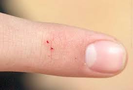 Image result for wolf spider bite skin