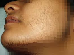 Lalu, bagaimana cara mencegah iritasi kulit akibat mencukur bulu kemaluan? Hukum Perempuan Membuang Bulu Di Wajah Kerana Malu