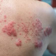 Whether the trigger is allergic or not, a complex release of inflammatory mediators, including histamine from cutaneous mast cells, results in fluid leakage from superficial blood vessels. Kev0w0vcdljs6m