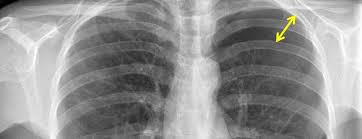 Bilateral simultaneous thoracotomy for unilateral spontaneous pneumothorax, with spetial referens to the. Der Spontanpneumothorax Swiss Medical Forum
