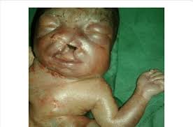 This is a legal process, because if there is a criminal in a. Post Mortem Image Of The Face Showing Labiopalatine Cleft Download Scientific Diagram