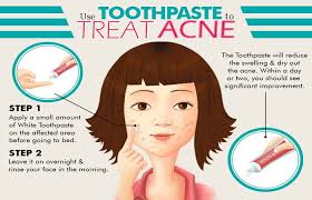 Use Toothpaste To Treat Acne Wash Your Face Dry It And Put Toothpaste On Your Nose And Something Amazi How To Treat Acne Acne Remedies Cystic Acne Remedies