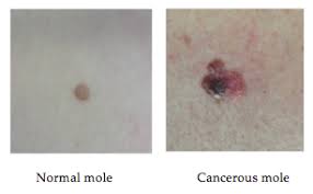 Get to a knowing your body and all of its unique spots is the first step in knowing what to look for when it comes to while squamous cell carcinoma can look like a flat area closely resembling healthy skin. First Symptoms Of Melanoma Three Types To Watch Out For