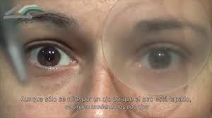 Por Que Si Desvio Un Ojo Mi Oftalmologo Aconseja Operar Los Dos