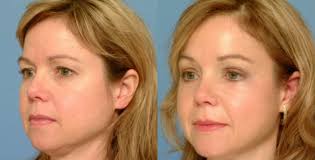 Brow Lift Forehead Lift Surgery Before After Brow Lift Surgery Brow Lift Forehead Lift