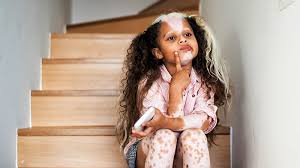 Image result for Vitiligo