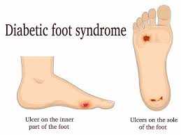 Image result for diabetic toes