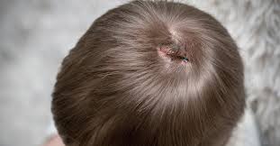 Image result for sores on the head in children
