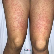 Image result for allergy rash on the legs