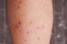 Image result for scabies human bites