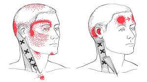 47 Prototypic Travell Trigger Point Chart