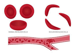 Sickle cell disease (scd) is a group of blood disorders typically inherited from a person's parents. Sickle Cell Disease